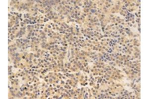 ABIN6265841 and ABIN6266669 at 1/100 staining human pituitary adenoma by IHC-P. (UBA7 Antikörper  (C-Term))