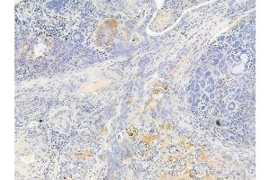 ABIN6262772 and ABIN6267008 at 1/100 staining human esophageal carcinoma by IHC-P. (KRT15 Antikörper  (N-Term))