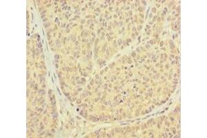 Immunohistochemistry of paraffin-embedded human ovarian cancer using ABIN7164935 at dilution of 1:100 (PSMF1 Antikörper  (AA 1-271))