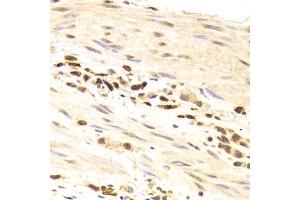 Immunohistochemistry of paraffin-embedded human gastric cancer using PRPF3 Antibody (ABIN5973192) at dilution of 1/100 (40x lens). (PRPF3 Antikörper)