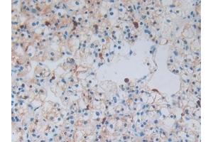 Detection of S100A8 in Human Renal cancer Tissue using Polyclonal Antibody to S100 Calcium Binding Protein A8 (S100A8) (S100A8 Antikörper  (AA 1-93))