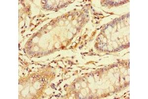 Immunohistochemistry of paraffin-embedded human colon cancer using ABIN7146751 at dilution of 1:100 (CES3 Antikörper  (AA 65-233))