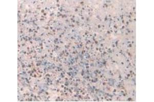 Detection of 0 in Human Rectum Cancer Tissue using Monoclonal Antibody to Amylin (Amylin/DAP Antikörper)