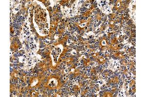 ABIN7095696 and ABIN7099758 at 1/100 staining human colorectal cancer by IHC-P.
