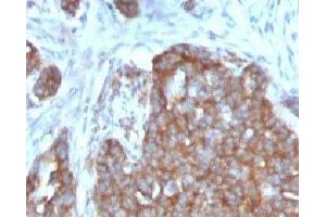 Formalin-fixed, paraffin-embedded human ovarian carcinoma stained with TFF1 antibody. (TFF1 Antikörper  (C-Term))