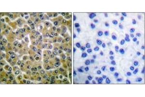 Immunohistochemistry analysis of paraffin-embedded human breast carcinoma, using PLCG2 (Phospho-Tyr753) Antibody. (Phospholipase C gamma 2 Antikörper  (pTyr753))