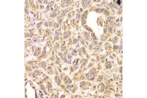Immunohistochemistry of paraffin-embedded human esophageal cancer using HSPA9 antibody at dilution of 1:200 (400x lens). (HSPA9 Antikörper)