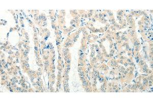 Immunohistochemistry of paraffin-embedded Human thyroid cancer tissue using RAB25 Polyclonal Antibody at dilution 1:50 (RAB25 Antikörper)