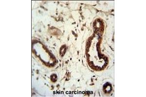 KRT82 Antibody (Center) (ABIN651240 and ABIN2840149) immunohistochemistry analysis in formalin fixed and paraffin embedded human skin carcinoma followed by peroxidase conjugation of the secondary antibody and DAB staining. (Keratin 82 Antikörper  (AA 312-341))