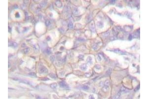 Immunohistochemistry analyzes of Csk antibody in paraffin-embedded human breast carcinoma tissue. (CSK Antikörper)