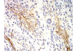 Immunohistochemical analysis of paraffin-embedded esophageal cancer tissues using KRT10 mouse mAb with DAB staining.