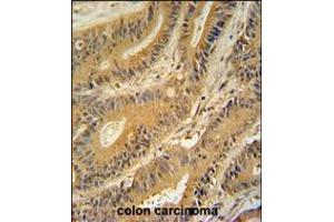 GNAT3 antibody immunohistochemistry analysis in formalin fixed and paraffin embedded human colon carcinoma followed by peroxidase conjugation of the secondary antibody and DAB staining. (GNAT3 Antikörper  (AA 78-105))
