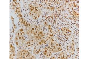 ABIN6256185 and ABIN6267192 at 1/100 staining Human breast cancer tissue by IHC-P. (tau Antikörper  (pSer202, pSer519))