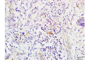 Formalin-fixed and paraffin embedded human colon carcinoma tissue labeled with Anti-RRM1 Polyclonal Antibody, Unconjugated  at 1:200 followed by conjugation to the secondary antibody, (SP-0023), and DAB staining (RRM1 Antikörper  (AA 733-778))