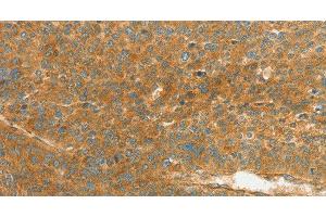 Immunohistochemistry of paraffin-embedded Human liver cancer using APOL2 Polyclonal Antibody at dilution of 1:80 (Apolipoprotein L 2 Antikörper)