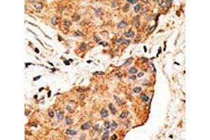 IHC analysis of FFPE human breast carcinoma tissue stained with the NRG1 antibody (Neuregulin 1 Antikörper  (AA 198-229))