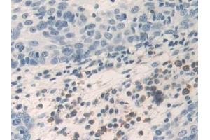 Detection of TNFa in Human Skin cancer Tissue using Polyclonal Antibody to Tumor Necrosis Factor Alpha (TNFa) (TNF alpha Antikörper  (AA 77-233))