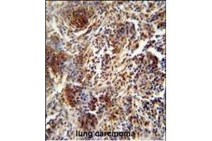 ZNF30 antibody (N-term) (ABIN654563 and ABIN2844269) immunohistochemistry analysis in formalin fixed and paraffin embedded human lung carcinoma followed by peroxidase conjugation of the secondary antibody and DAB staining.