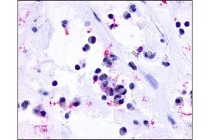 IHC staining of Nasal Mucosa (Allergic Rhinitis Eosinophils) using CysLT1 antibody ABIN122043. (CysLTR1 Antikörper  (3rd Extracellular Domain))