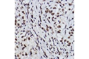 Immunohistochemistry of paraffin-embedded human breast cancer using Acetyl-Histone H3-K27 Rabbit mAb (ABIN3016650, ABIN3016651, ABIN3016652, ABIN1682513 and ABIN1682514) at dilution of 1:100 (40x lens). (Histone 3 Antikörper  (acLys27))
