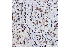 Immunohistochemistry of paraffin-embedded human breast cancer using Acetyl-Histone H3-K27 Rabbit mAb (ABIN3016650, ABIN3016651, ABIN3016652, ABIN1682513 and ABIN1682514) at dilution of 1:100 (40x lens). (Histone H3 (Acetyl K27) (acLys27) Antikörper)