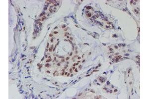 Immunohistochemical staining of paraffin-embedded Carcinoma of Human pancreas tissue using anti-TDO2 mouse monoclonal antibody.