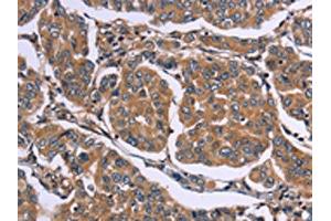 The image on the left is immunohistochemistry of paraffin-embedded Human breast cancer tissue using ABIN7190535(EGR4 Antibody) at dilution 1/20, on the right is treated with synthetic peptide. (EGR4 Antikörper)