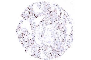 Ovarian clear cell carcinoma with strong nuclear p27 positivity of tumor cells