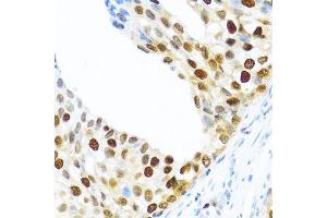 Immunohistochemistry of paraffin-embedded human prostate cancer using KHDRBS2 antibody.