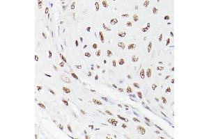 Immunohistochemistry of paraffin-embedded human esophageal cancer using LEO1 Rabbit pAb (ABIN6133790, ABIN6143141 and ABIN7101832) at dilution of 1:100 (40x lens). (LEO1 Antikörper)