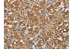 The image on the left is immunohistochemistry of paraffin-embedded Human thyroid cancer tissue using ABIN7190675(FOXB1 Antibody) at dilution 1/30, on the right is treated with synthetic peptide.