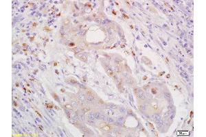 Formalin-fixed and paraffin embedded human lung carcinoma labeled with Rabbit Anti CXorf36 Polyclonal Antibody, Unconjugated  at 1:200 followed by conjugation to the secondary antibody and DAB staining (CXORF36 Antikörper  (AA 91-182))
