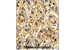 Formalin-fixed and paraffin-embedded human hepatocarcinoma with SFRP5 Antibody (Center), which was peroxidase-conjugated to the secondary antibody, followed by DAB staining. (SFRP5 Antikörper  (AA 219-248))