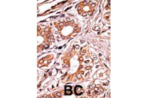 Immunohistochemistry (IHC) image for anti-Retinoblastoma 1 (RB1) (pSer249) antibody (ABIN3001781)