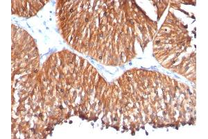 Formalin-fixed, paraffin-embedded human Bladder Carcinoma stained with HSP60 Mouse Monoclonal Antibody (HSPD1/780) (HSPD1 Antikörper)