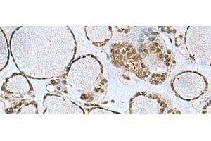 Immunohistochemistry of paraffin-embedded Human thyroid cancer tissue using PTPA Polyclonal Antibody at dilution of 1:50(x200) (PPP2R4 Antikörper)