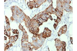Formalin-fixed, paraffin-embedded human Colon Carcinoma stained with Cytokeratin 20 (KRT20) Mouse Monoclonal Antibody (KRT20/1993). (KRT20 Antikörper  (AA 196-323))