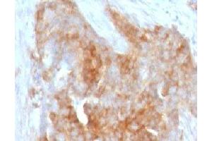 IHC testing of FFPE human ovarian carcinoma with Fascin antibody (clone FAN55-1) (Fascin Antikörper)