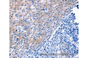 Immunohistochemistry of Human liver cancer using LAMA3 Polyclonal Antibody at dilution of 1:30