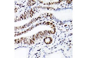 Immunohistochemistry of paraffin-embedded human colon carcinoma using MCM2 Rabbit mAb (ABIN7268538) at dilution of 1:100 (40x lens). (MCM2 Antikörper)