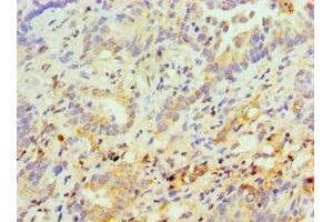 Immunohistochemistry of paraffin-embedded human lung cancer using ABIN7158299 at dilution of 1:100 (CD43 Antikörper  (AA 276-400))