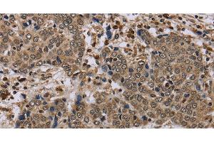 Immunohistochemistry of paraffin-embedded Human liver cancer tissue using NLRP4 Polyclonal Antibody at dilution 1:40 (NLRP4 Antikörper)