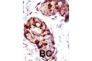 Formalin-fixed and paraffin-embedded human cancer tissue reacted with the primary antibody, which was peroxidase-conjugated to the secondary antibody, followed by AEC staining. (TSG101 Antikörper  (N-Term))