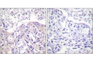 Immunohistochemistry analysis of paraffin-embedded human breast carcinoma, using ADD1 (Phospho-Thr445) Antibody. (alpha Adducin Antikörper  (pThr445))