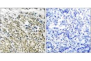 Immunohistochemistry analysis of paraffin-embedded human prostate carcinoma, using Androgen Receptor (Ab-213) Antibody. (Androgen Receptor Antikörper  (AA 186-235))