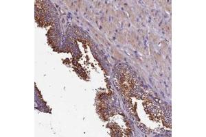 Immunohistochemical staining of human prostate with CLN5 polyclonal antibody  shows strong cytoplasmic positivity in glandular cells. (CLN5 Antikörper)