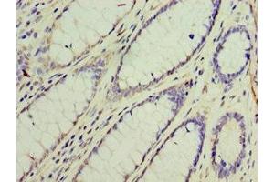 Immunohistochemistry of paraffin-embedded human colon cancer using ABIN7154312 at dilution of 1:100 (GS28 Antikörper  (AA 1-115))