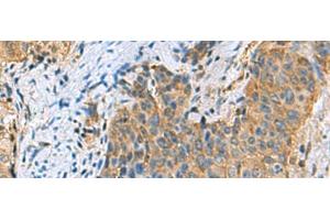 Immunohistochemistry of paraffin-embedded Human cervical cancer tissue using PSMA6 Polyclonal Antibody at dilution of 1:90(x200) (PSMA6 Antikörper)