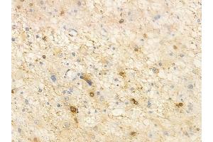 ABIN6261315 and ABIN6266717 at 1/100 staining human astrocytoma by IHC-P. (DLX3 Antikörper  (Internal Region))