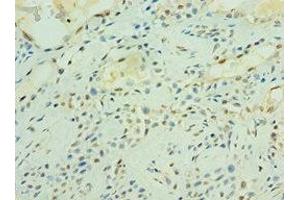 Immunohistochemistry of paraffin-embedded human breast cancer using ABIN7166484 at dilution of 1:100 (MAS1 Antikörper  (AA 246-325))